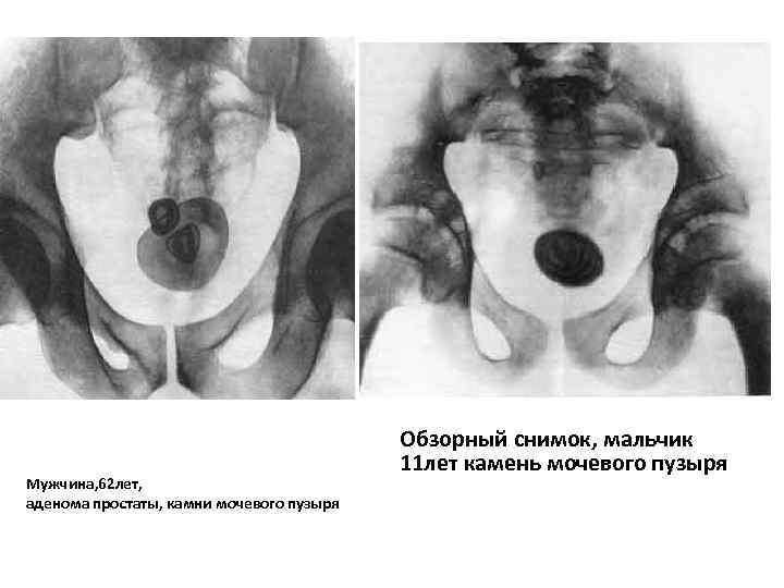 Мужчина, 62 лет, аденома простаты, камни мочевого пузыря Обзорный снимок, мальчик 11 лет камень