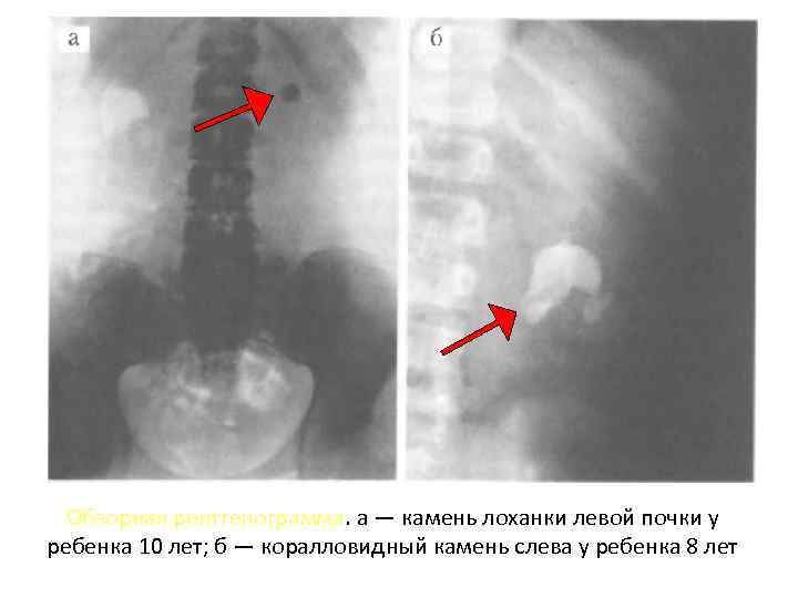 Обзорная рентгенограмма. а — камень лоханки левой почки у ребенка 10 лет; б —