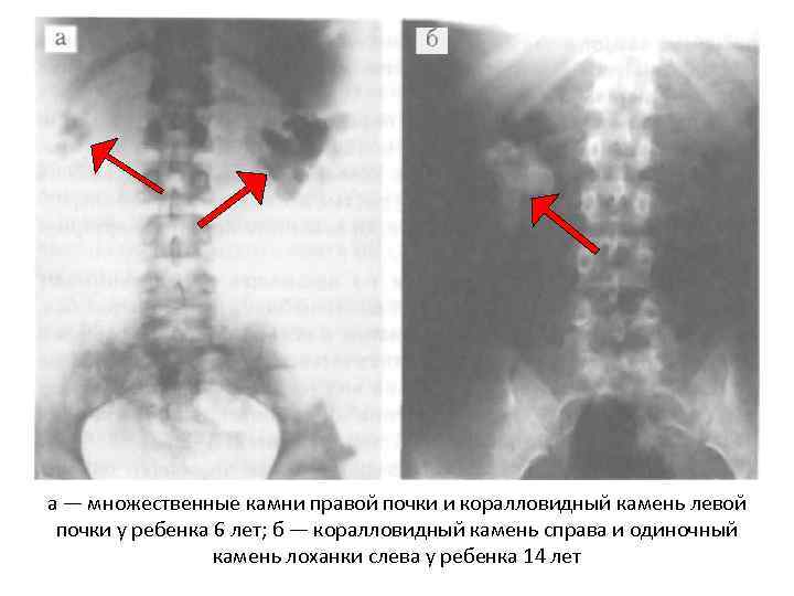 а — множественные камни правой почки и коралловидный камень левой почки у ребенка 6