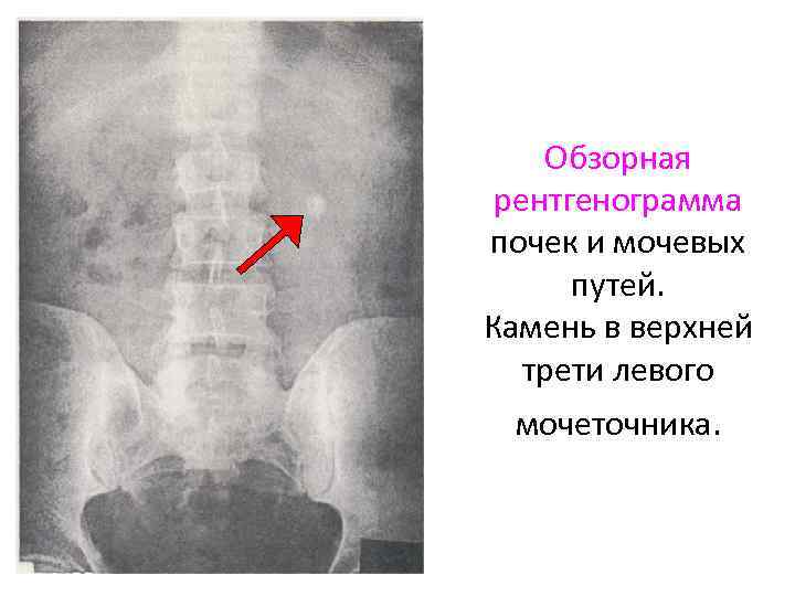 Обзорная рентгенограмма почек и мочевых путей. Камень в верхней трети левого мочеточника. 