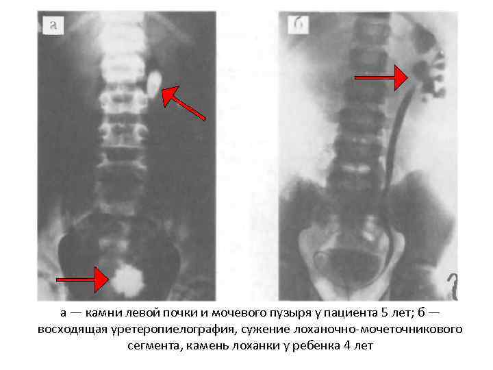а — камни левой почки и мочевого пузыря у пациента 5 лет; б —