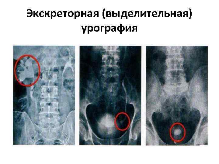 Экскреторная (выделительная) урография 