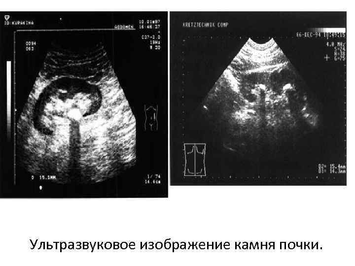 Ультразвуковое изображение серозоцеле представлено