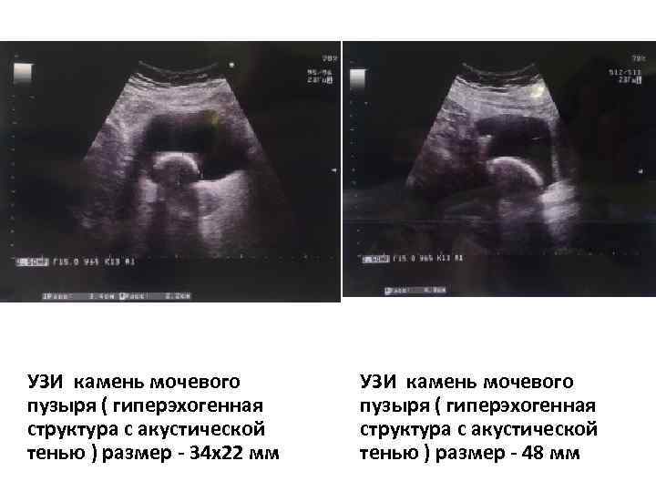 УЗИ камень мочевого пузыря ( гиперэхогенная структура с акустической тенью ) размер - 34