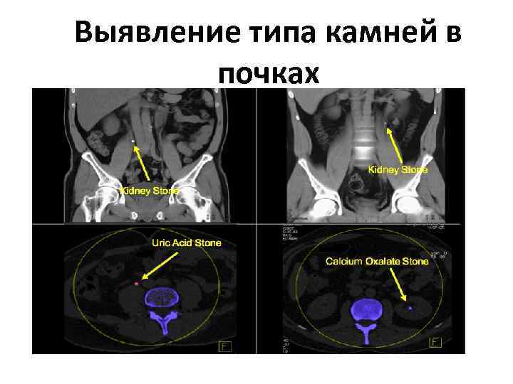 Выявление типа камней в почках 