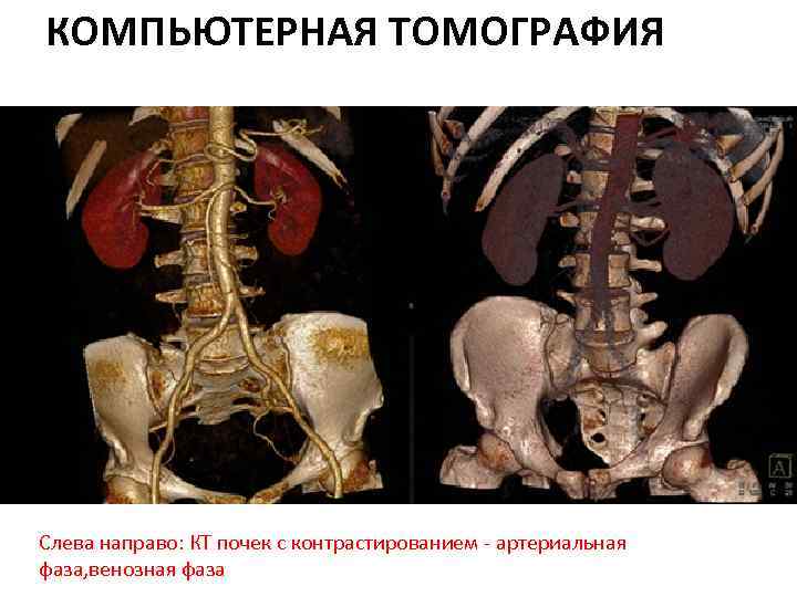 КОМПЬЮТЕРНАЯ ТОМОГРАФИЯ Слева направо: КТ почек с контрастированием - артериальная фаза, венозная фаза 