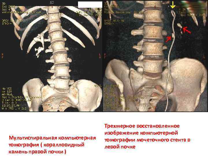 Мультиспиральная компьютерная томография ( коралловидный камень правой почки ) Трехмерное восстановленное изображение компьютерной томографии