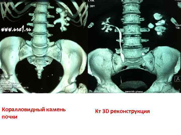 Коралловидный камень в почке фото