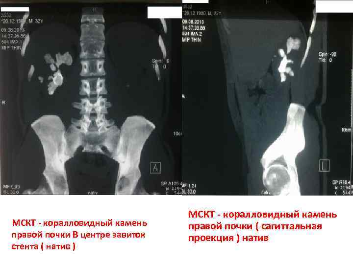 МСКТ - коралловидный камень правой почки В центре завиток стента ( натив ) МСКТ