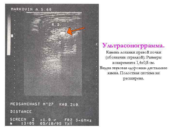 Ультрасоногррамма. Камень лоханки правой почки (обозначен стрелкой). Размеры конкремента 1, 4 x 0, 8