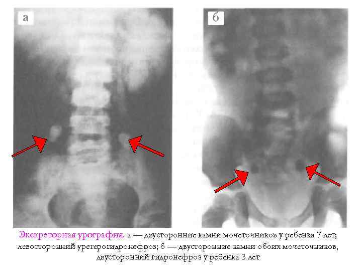 Экскреторная урография. а — двусторонние камни мочеточников у ребенка 7 лет; левосторонний уретерогидронефроз; б