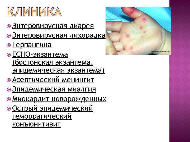  Энтеровирусная диарея Энтеровирусная лихорадка Герпангина ECHO-экзантема (бостонская экзантема, эпидемическая экзантема) Асептический менингит Эпидемическая