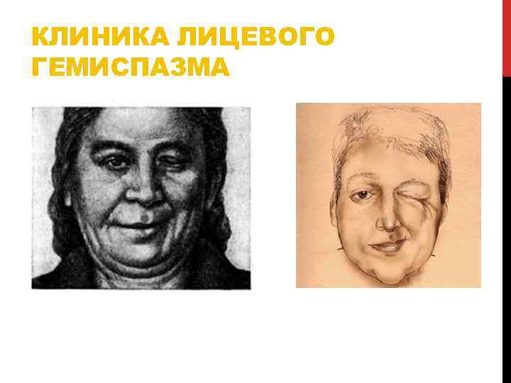 КЛИНИКА ЛИЦЕВОГО ГЕМИСПАЗМА 