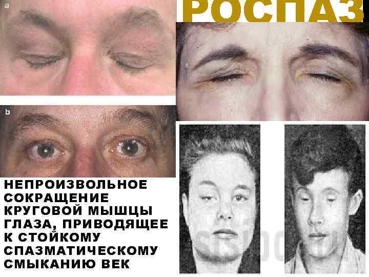 РОСПАЗ МНЕПРОИЗВОЛЬНОЕ СОКРАЩЕНИЕ КРУГОВОЙ МЫШЦЫ ГЛАЗА, ПРИВОДЯЩЕЕ К СТОЙКОМУ СПАЗМАТИЧЕСКОМУ СМЫКАНИЮ ВЕК 