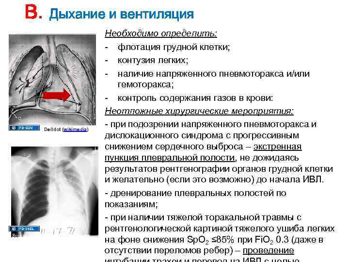 Методы борьбы с флотацией грудной стенки при множественных фрагментарных переломах ребер