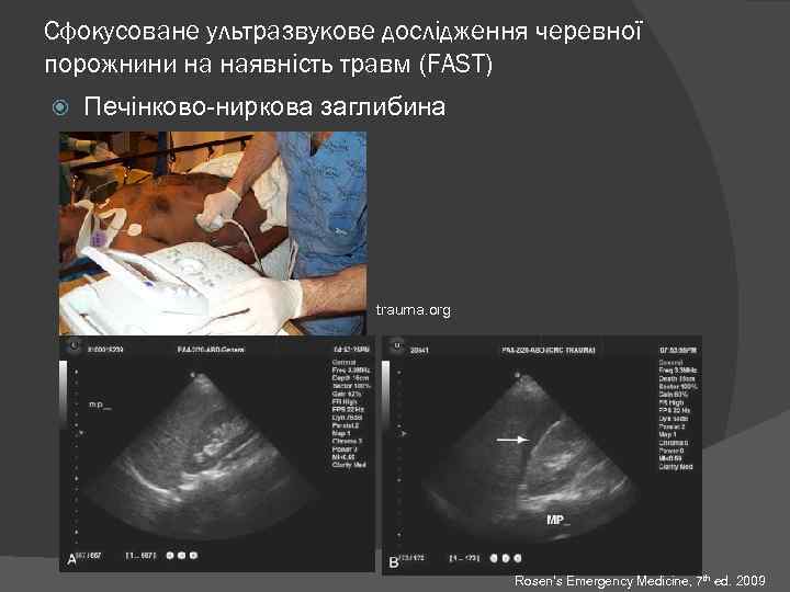 Сфокусоване ультразвукове дослідження черевної порожнини на наявність травм (FAST) Печінково-ниркова заглибина trauma. org Rosen’s