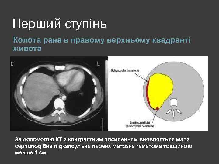 Перший ступінь Колота рана в правому верхньому квадранті живота За допомогою КТ з контрастним