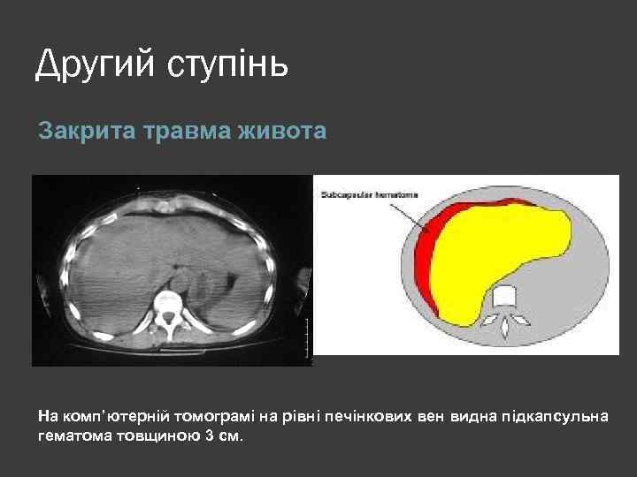 Другий ступінь Закрита травма живота На комп’ютерній томограмі на рівні печінкових вен видна підкапсульна