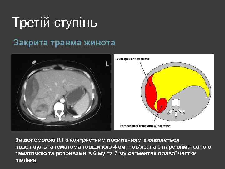 Третій ступінь Закрита травма живота За допомогою КТ з контрастним посиленням виявляється підкапсульна гематома