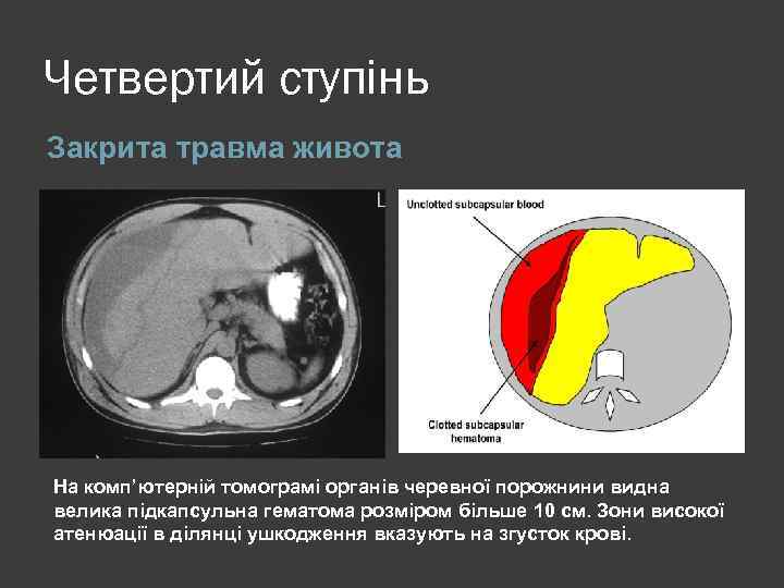 Четвертий ступінь Закрита травма живота На комп’ютерній томограмі органів черевної порожнини видна велика підкапсульна