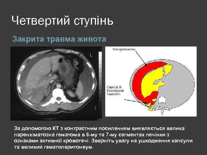 Четвертий ступінь Закрита травма живота За допомогою КТ з контрастним посиленням виявляється велика паренхіматозна