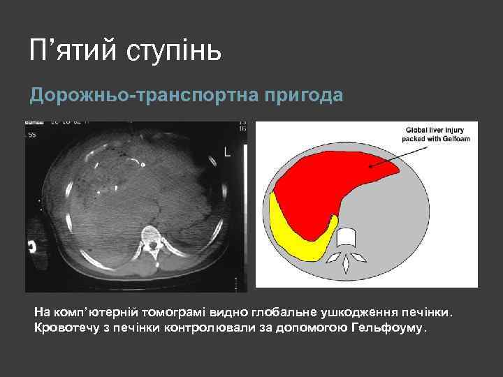 П’ятий ступінь Дорожньо-транспортна пригода На комп’ютерній томограмі видно глобальне ушкодження печінки. Кровотечу з печінки