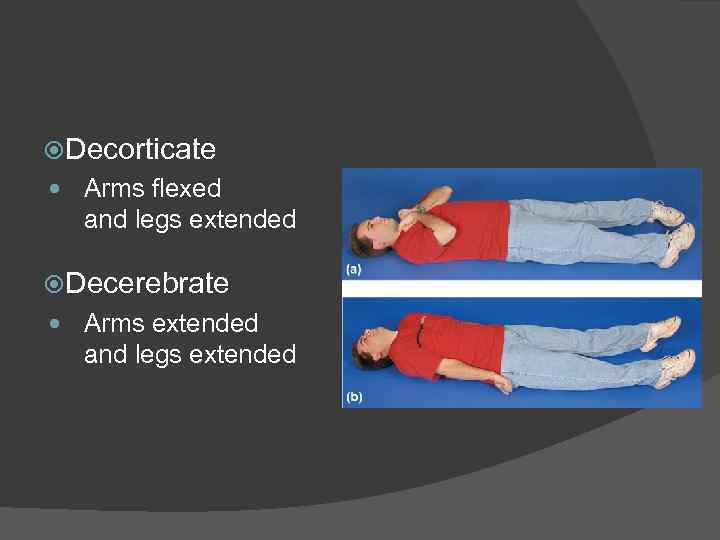  Decorticate Arms flexed and legs extended Decerebrate Arms extended and legs extended 