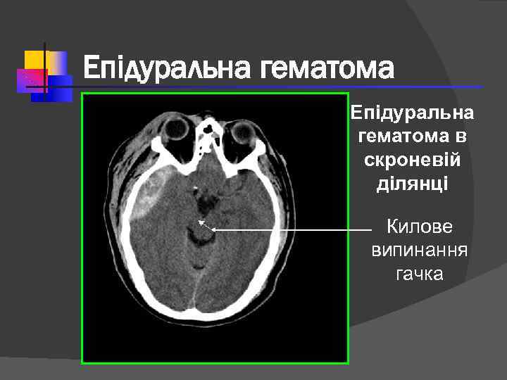 Епідуральна гематома в скроневій ділянці Килове випинання гачка 