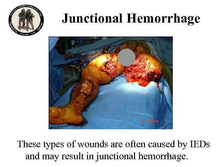 Junctional Hemorrhage These types of wounds are often caused by IEDs and may result