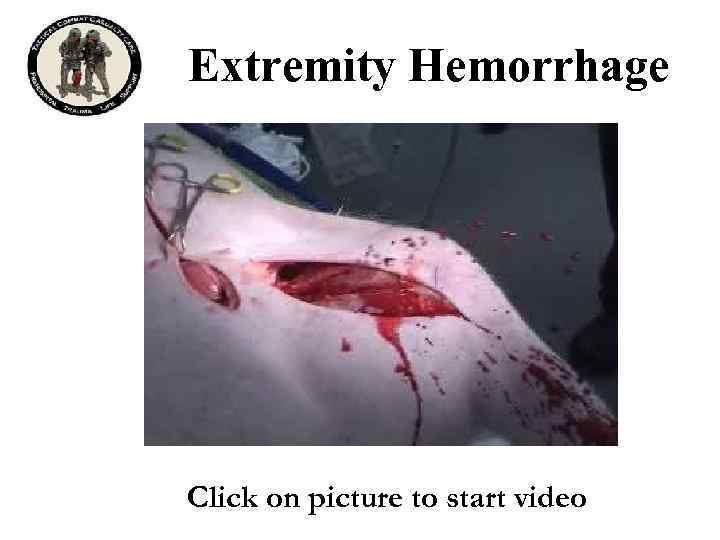 Extremity Hemorrhage Click on picture to start video 