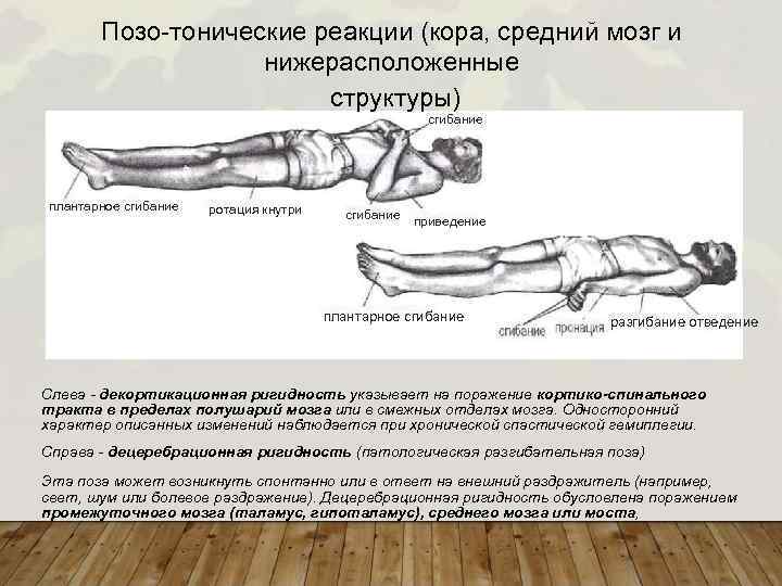 Позо-тонические реакции (кора, средний мозг и нижерасположенные структуры) сгибание плантарное сгибание ротация кнутри сгибание