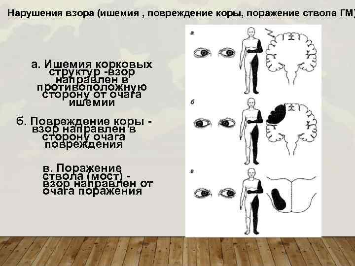 Расстройство схемы тела отмечается при поражении