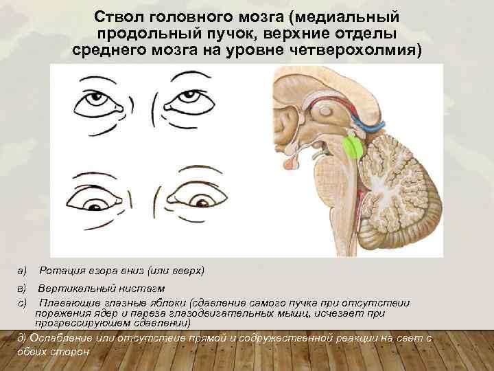 Ствол головного мозга (медиальный продольный пучок, верхние отделы среднего мозга на уровне четверохолмия) a)