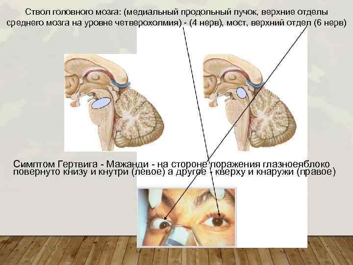 Ствол головного мозга: (медиальный продольный пучок, верхние отделы среднего мозга на уровне четверохолмия) -