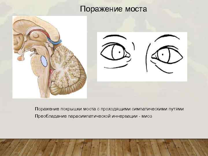 Поражение моста Поражение покрышки моста с проходящими симпатическими путями Преобладание парасимпатической иннервации - миоз