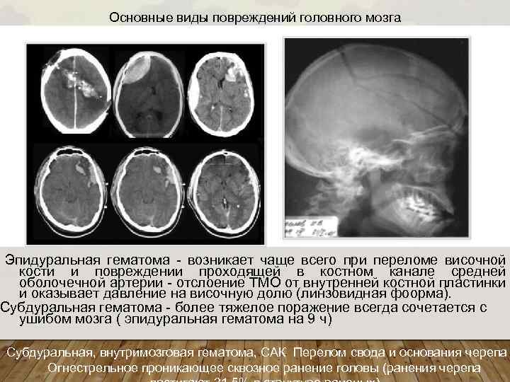 Гематома головного мозга прогноз. Эпидуральная гематома височной области кт. Операция при эпидуральной гематоме. Оболочечная артерия эпидуральная гематома. Перелом борозды средней оболочечной артерии.