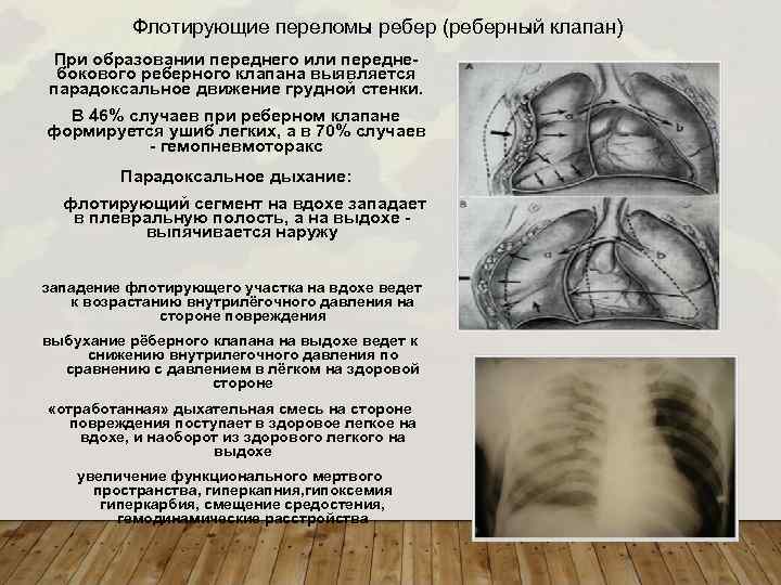 Флотирующие переломы ребер (реберный клапан) При образовании переднего или переднебокового реберного клапана выявляется парадоксальное