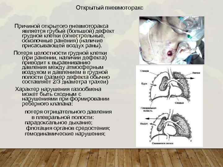 Открытый пневмоторакс Причиной открытого пневмоторакса является грубый (большой) дефект грудной клетки (огнестрельные, осколочные ранения)