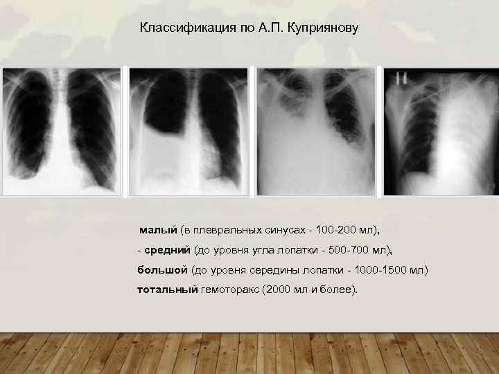 Классификация по А. П. Куприянову малый (в плевральных синусах - 100 -200 мл), -