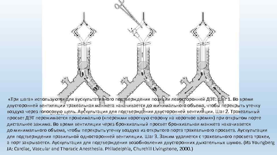  «Три шага» используются для аускультативного подтверждения позиции левосторонней ДЭТ: Шаг 1. Во время