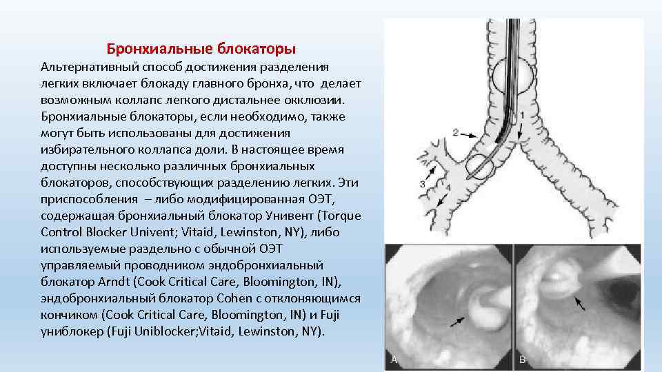 Бронхиальные блокаторы Альтернативный способ достижения разделения легких включает блокаду главного бронха, что делает возможным