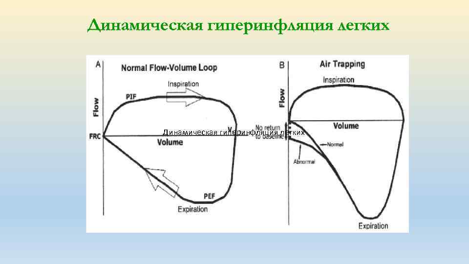 Динамическая гиперинфляция легких 