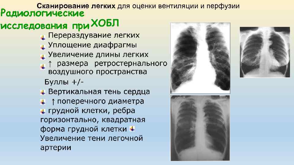 Сканирование легких для оценки вентиляции и перфузии Радиологические исследования при 