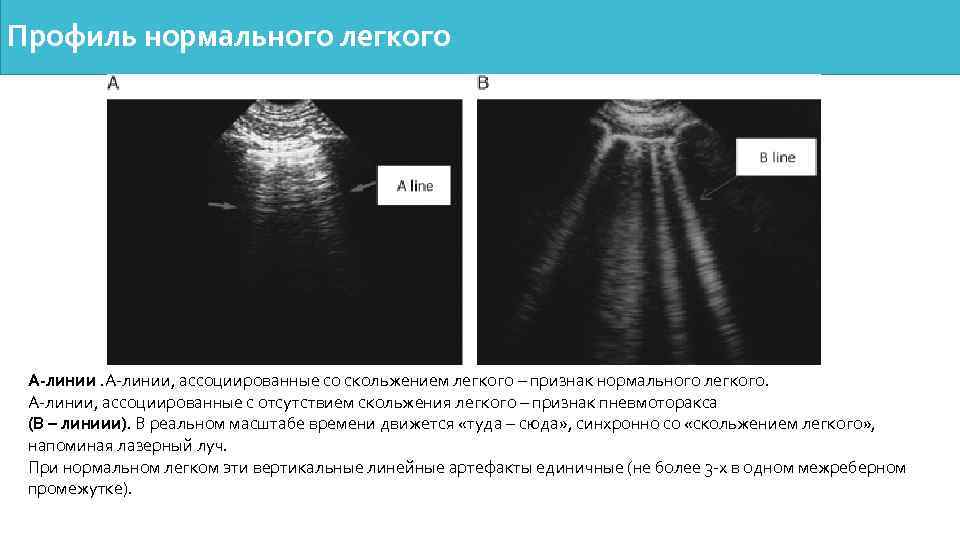 Профиль нормального легкого А-линии, ассоциированные со скольжением легкого – признак нормального легкого. А-линии, ассоциированные