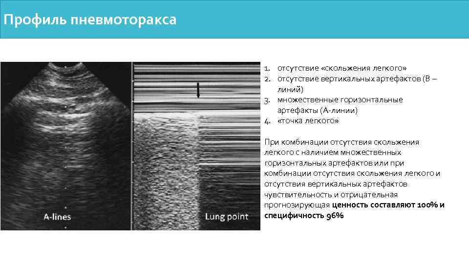 Профиль пневмоторакса 1. отсутствие «скольжения легкого» 2. отсутствие вертикальных артефактов (В – линий) 3.