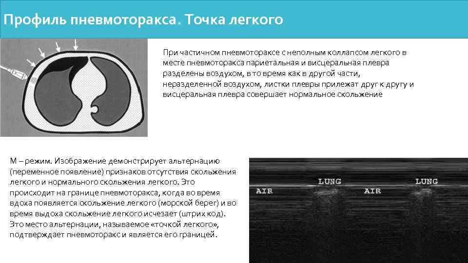Профиль пневмоторакса. Точка легкого При частичном пневмотораксе с неполным коллапсом легкого в месте пневмоторакса