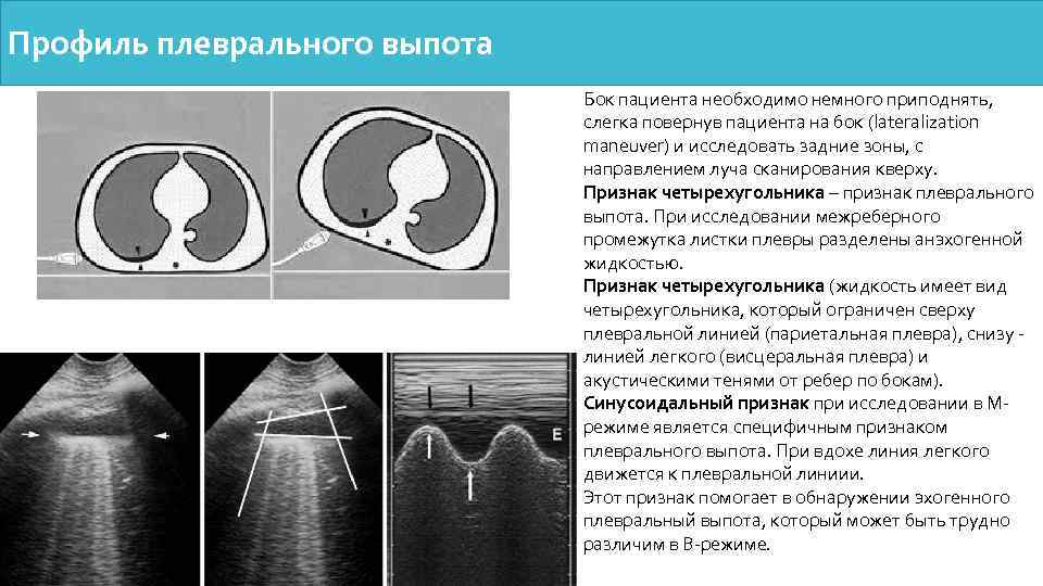 Узи плевральной полости. Признаки плеврального выпота. Плевральный выпот симптомы. Жидкость в плевральной полости кт.