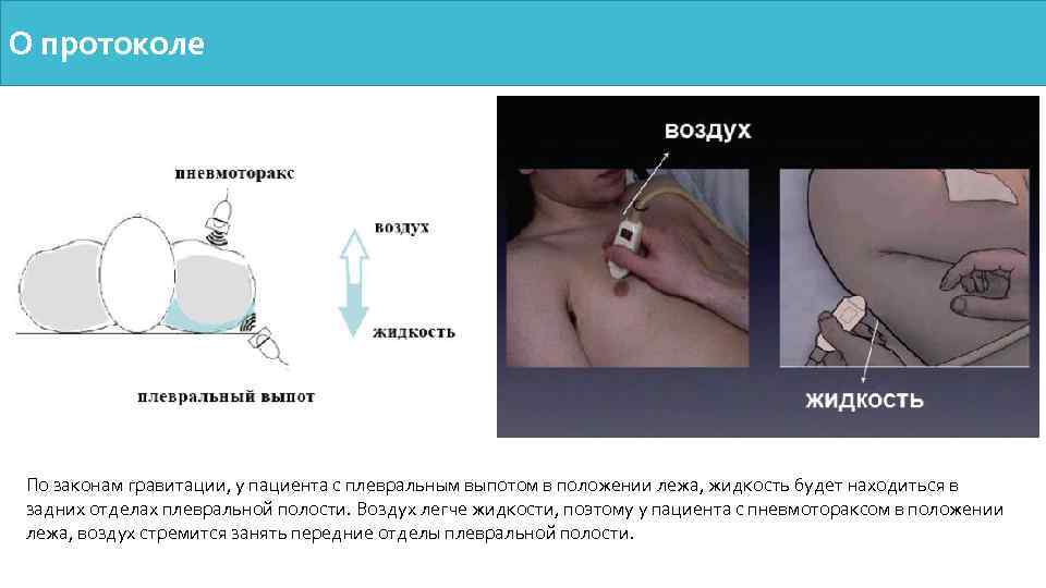 О протоколе По законам гравитации, у пациента с плевральным выпотом в положении лежа, жидкость