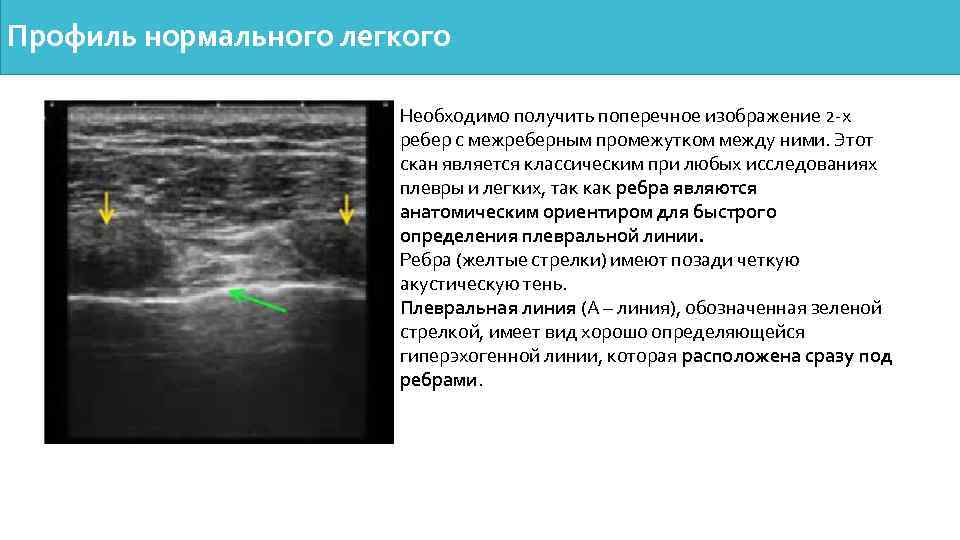 Профиль нормального легкого Необходимо получить поперечное изображение 2 -х ребер с межреберным промежутком между