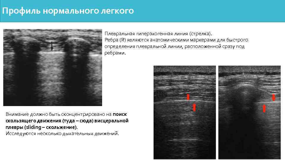 Профиль нормального легкого Плевральная гиперэхогенная линия (стрелка). Ребра (R) являются анатомическими маркерами для быстрого